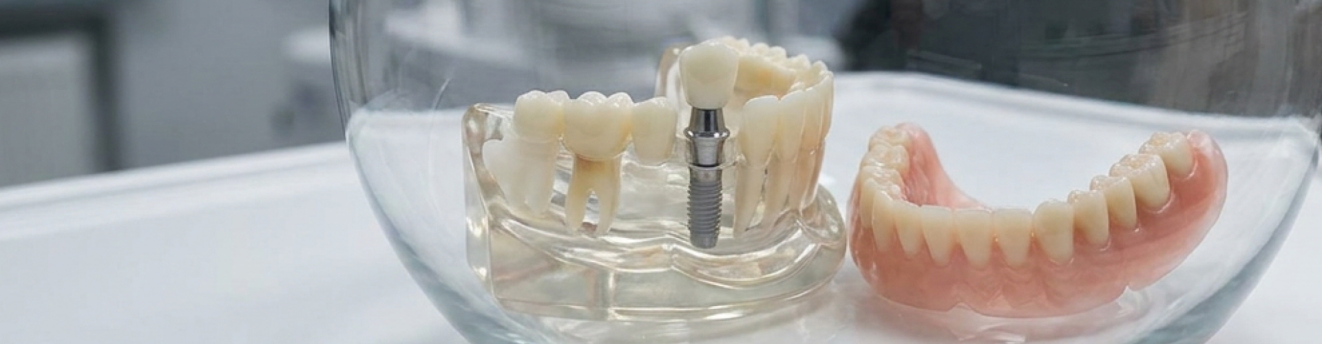 Model jaw with a dental implant and cantilever bridge next to a full denture.
